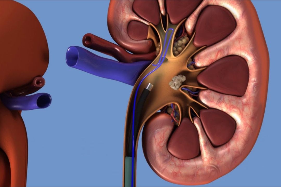 Ουρητηρολιθοτριψία (Ημιακάμπτη - Εύκαμπτη)