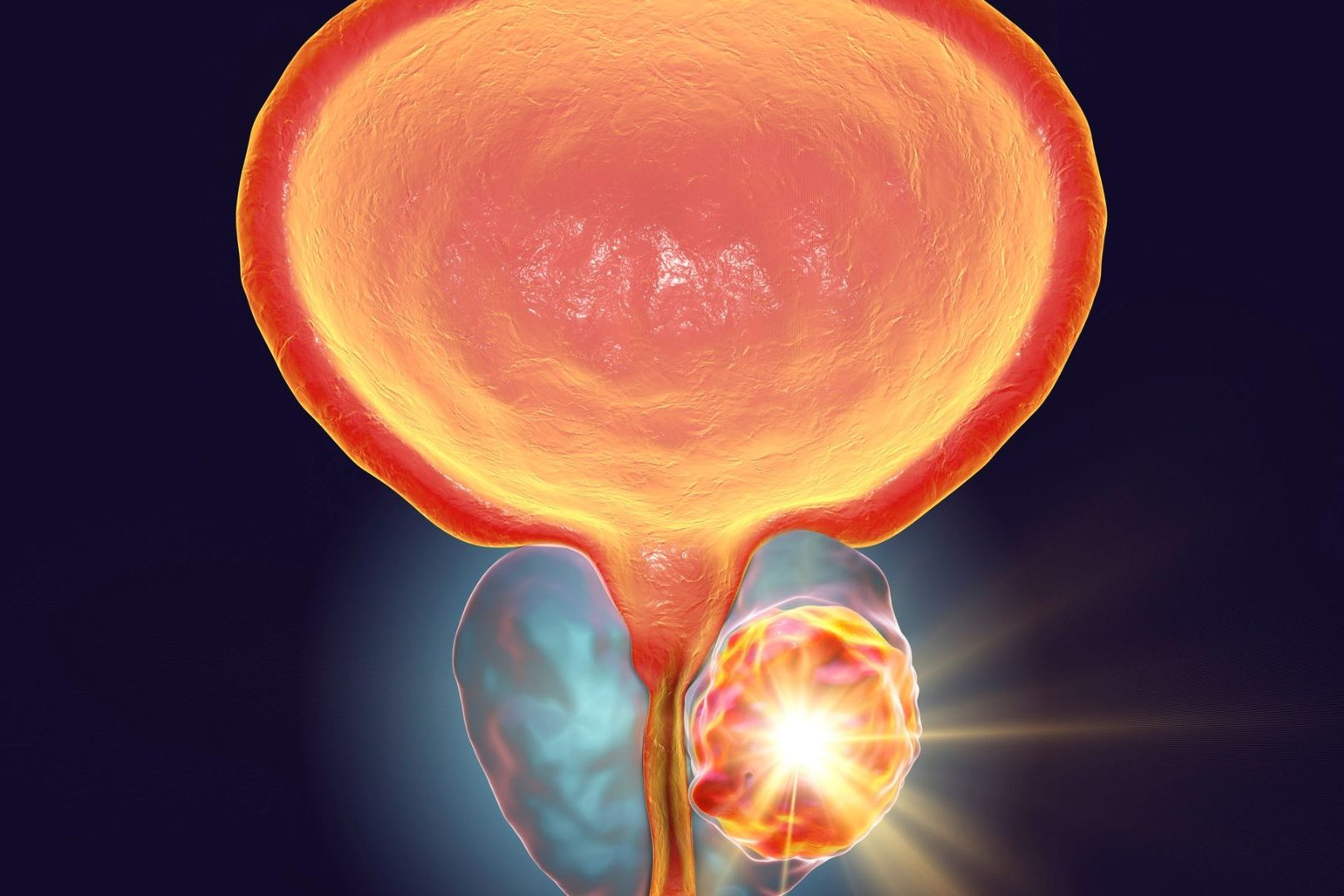 Καρκίνος Προστάτη – Νεότερες οδηγίες για τους ασθενείς χαμηλού κινδύνου από το NCCN