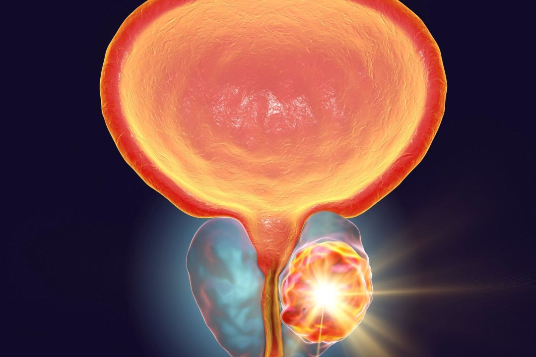 Καρκίνος Προστάτη – Νεότερες οδηγίες για τους ασθενείς χαμηλού κινδύνου από το NCCN