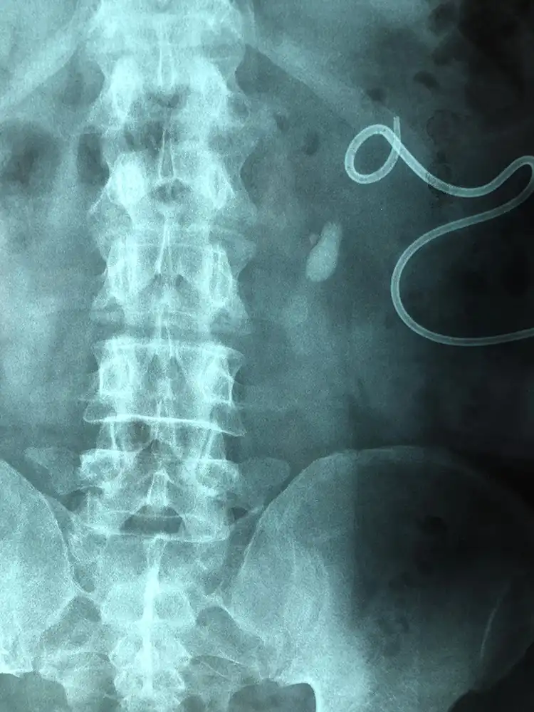 Λίθος νεφρού. Εύκαμπτη laser νεφρολιθοθρυψία.