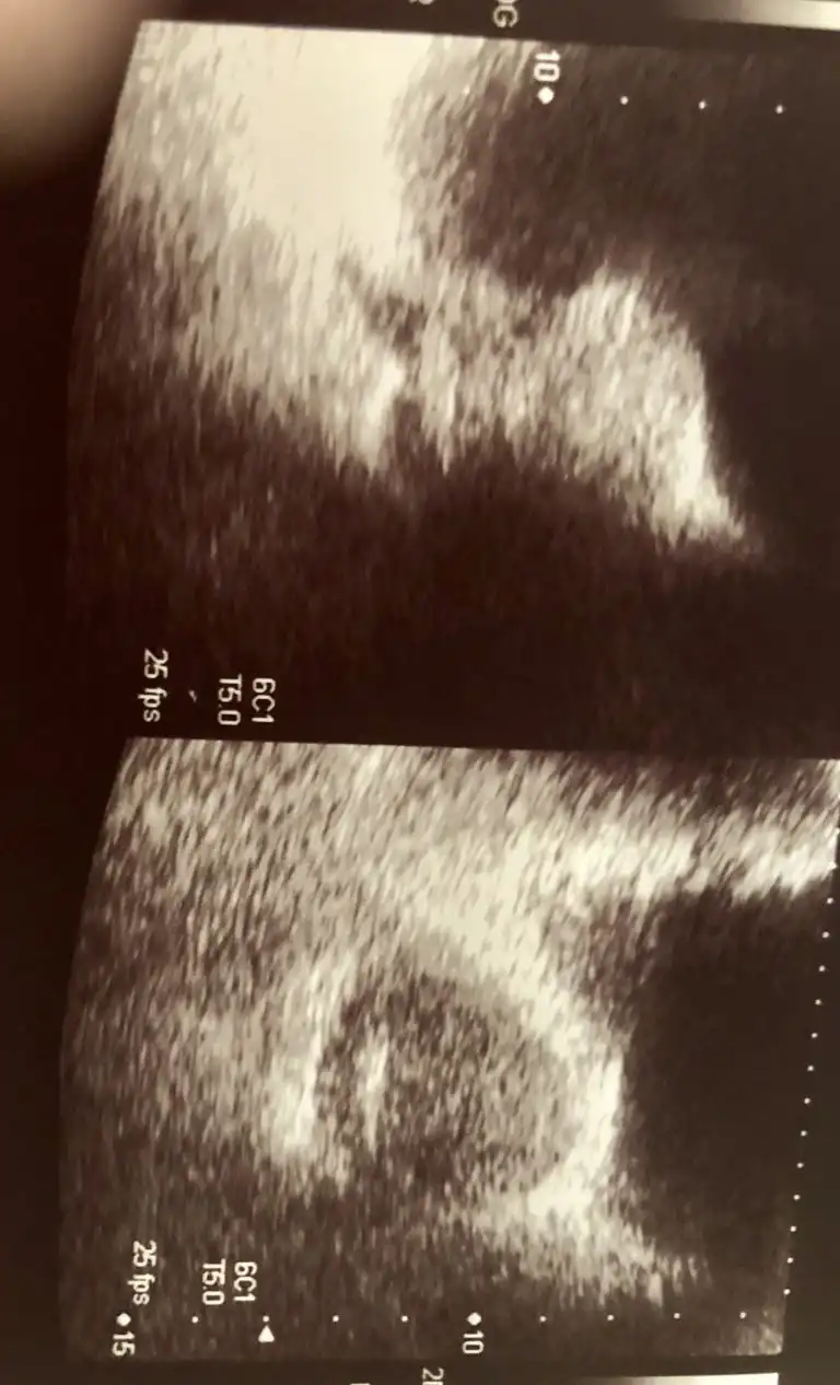 Καλοήθης υπερπλασία προστάτη ΚΥΠ: Εικόνα υπέρηχου