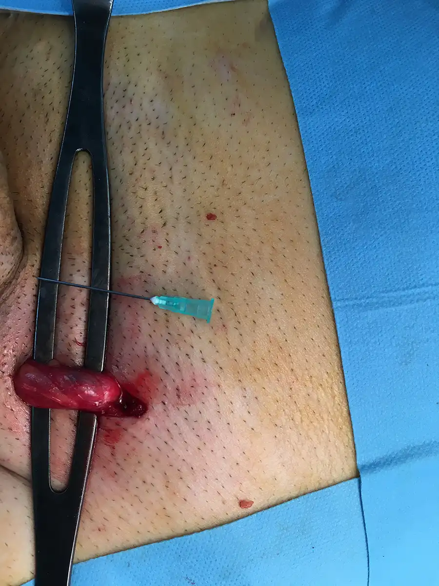 Η υποβουβωνική τομή, περίπου 2 εκ.