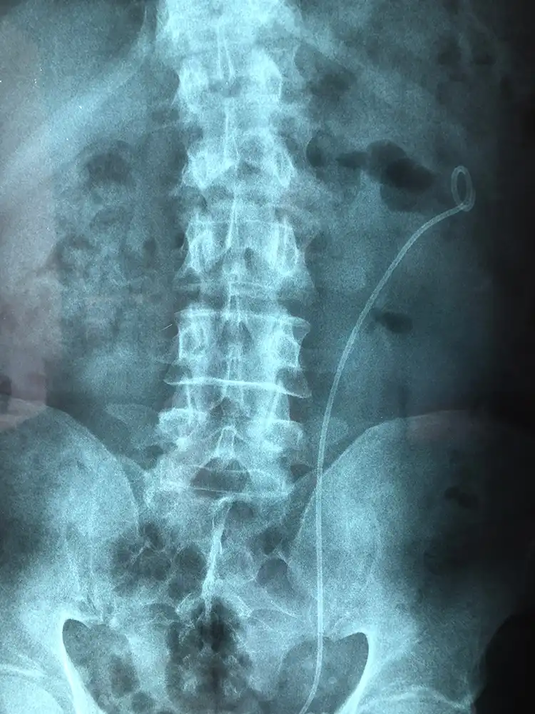 Λίθος νεφρού. Εύκαμπτη laser νεφρολιθοθρυψία.