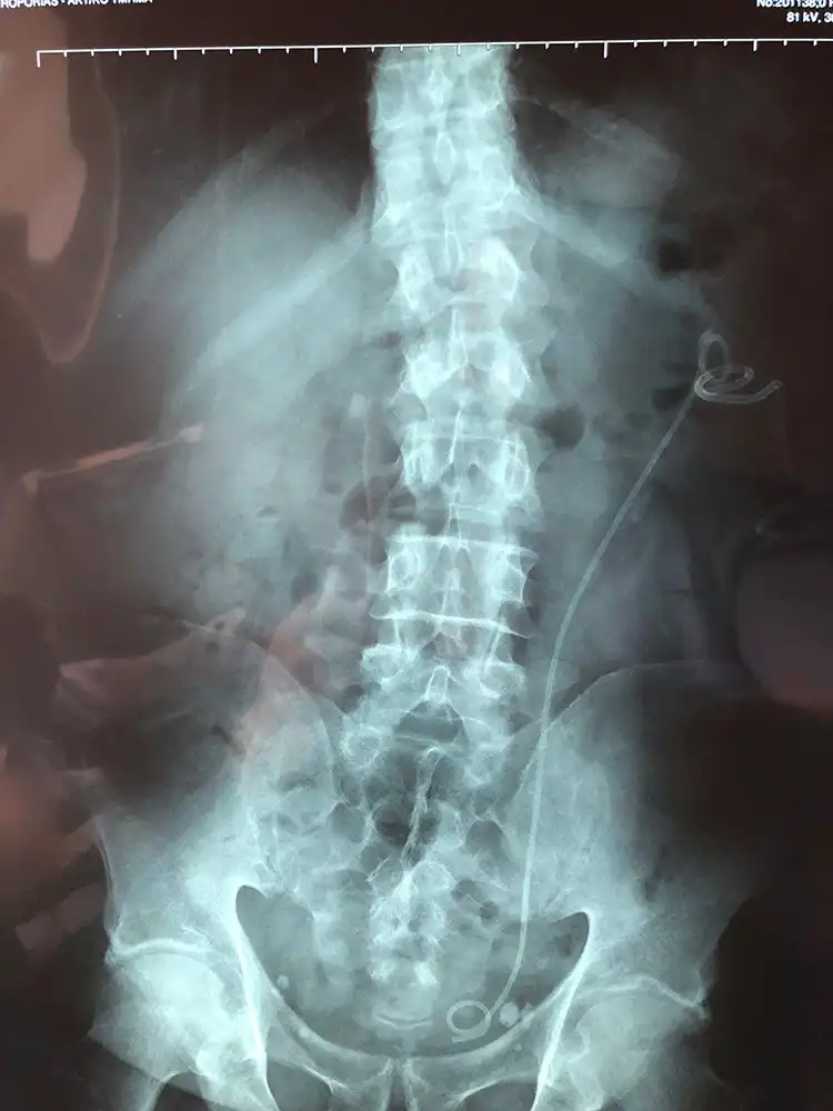 Λίθος νεφρού. Εύκαμπτη laser νεφρολιθοθρυψία.