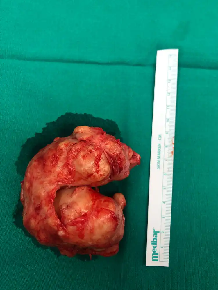 Παρασκεύασμα ανοιχτής Προστατεκτομής. Απεικονίζεται το ευμέγεθες αδένωμα που όπως φαίνεται αντιστοιχεί σε διάμετρο 10 εκ . και συνολικού βάρους 200 γρ. από τη βιοψία