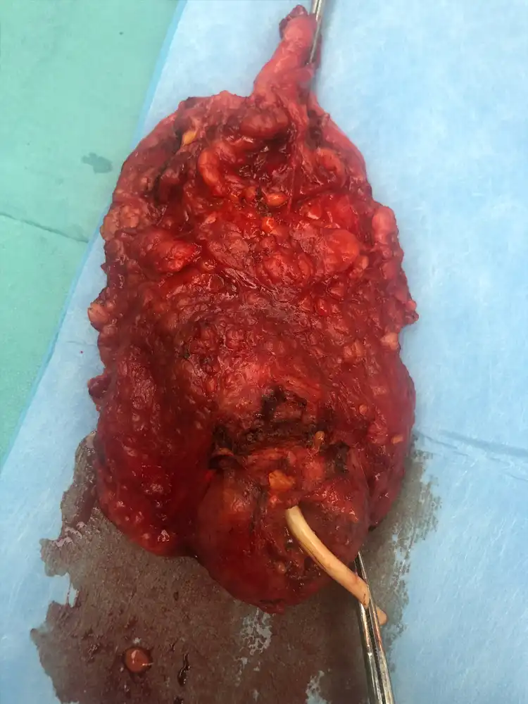 Παρασκεύασμα Ριζικής Κυστεκτομής σε άνδρα 75 ετών με Διηθητική νόσο.