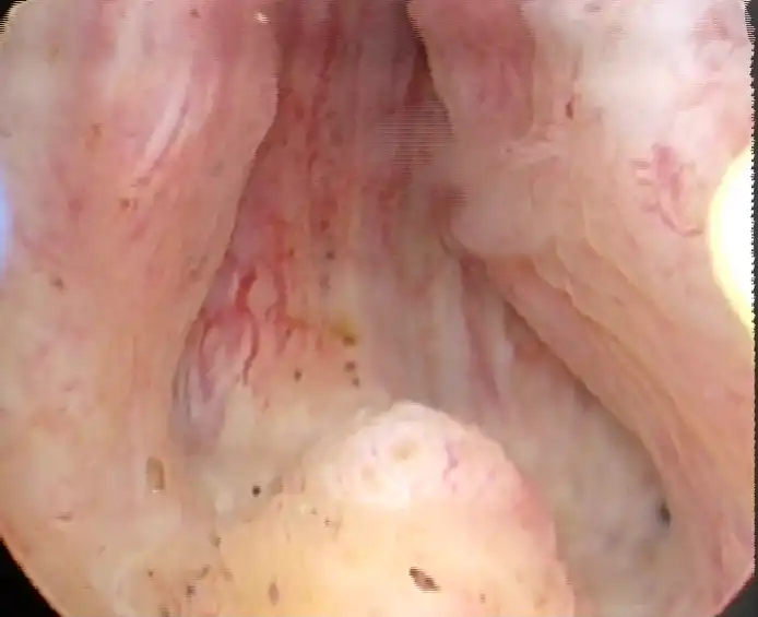 Καλοήθης υπερπλασία προστάτη ΚΥΠ