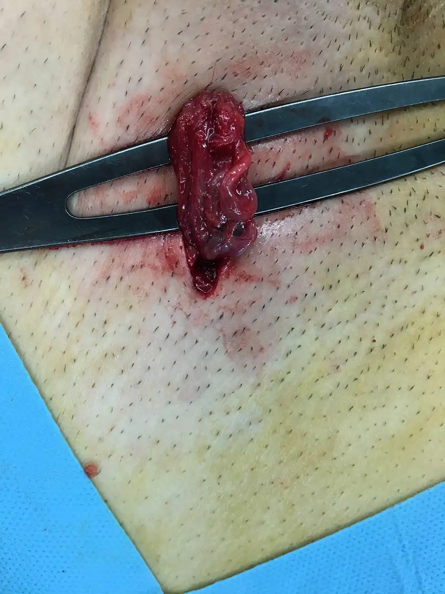 Η υποβουβωνική τομή, περίπου 2 εκ.