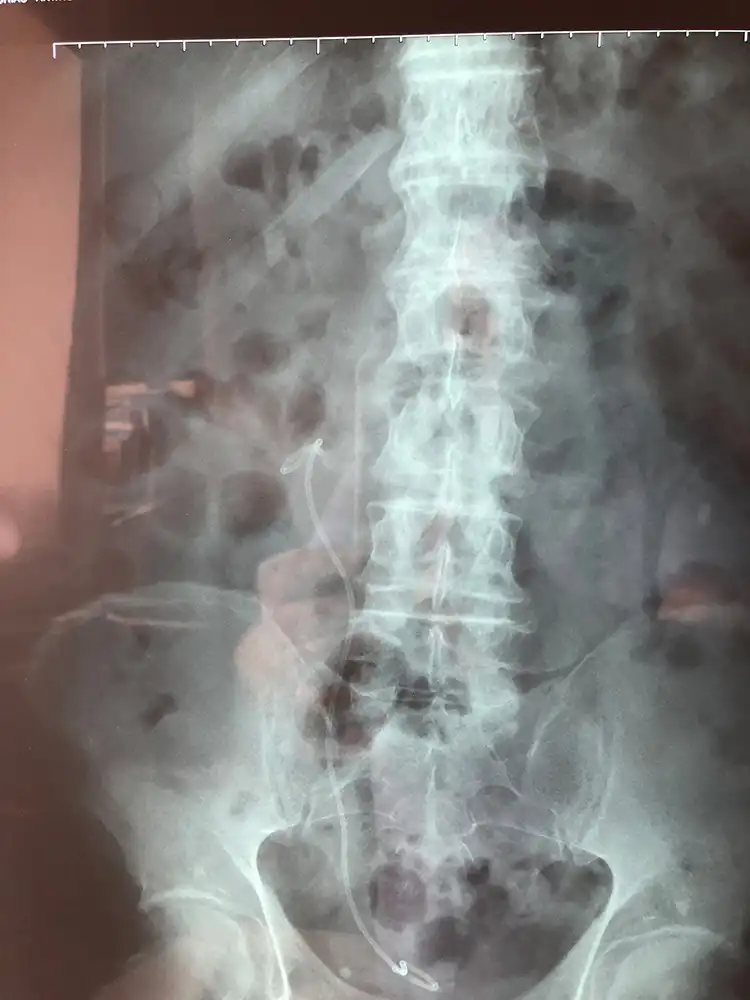 Λίθος νεφρού. Εύκαμπτη laser νεφρολιθοθρυψία.