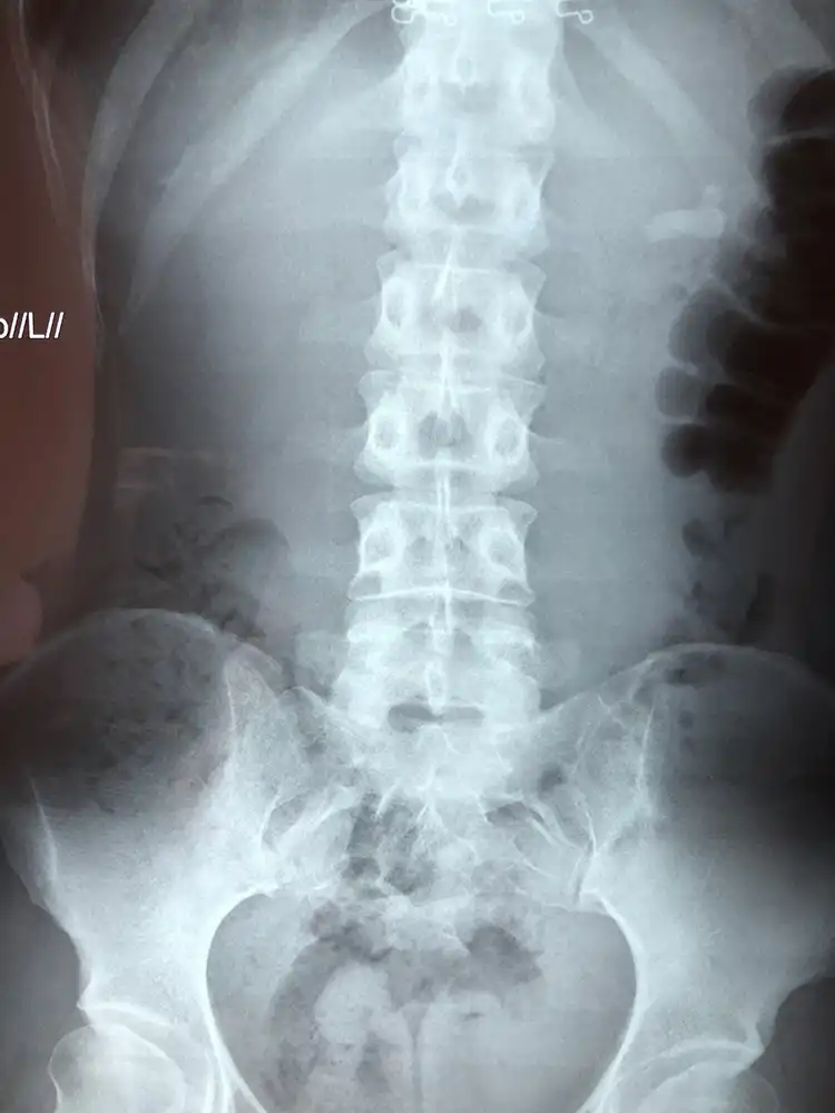 Λίθος νεφρού. Εύκαμπτη laser νεφρολιθοθρυψία.