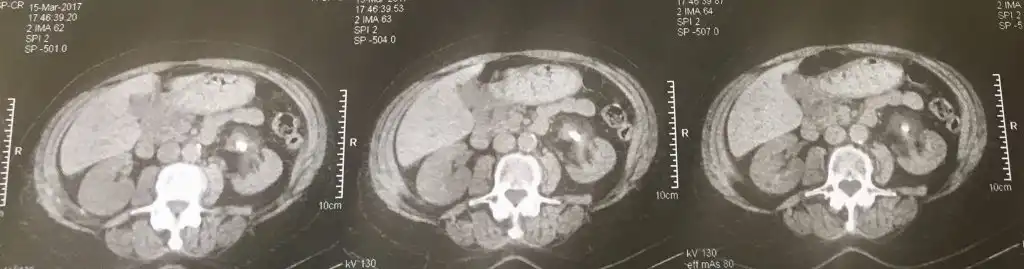 Λίθος νεφρού. Εύκαμπτη laser νεφρολιθοθρυψία.