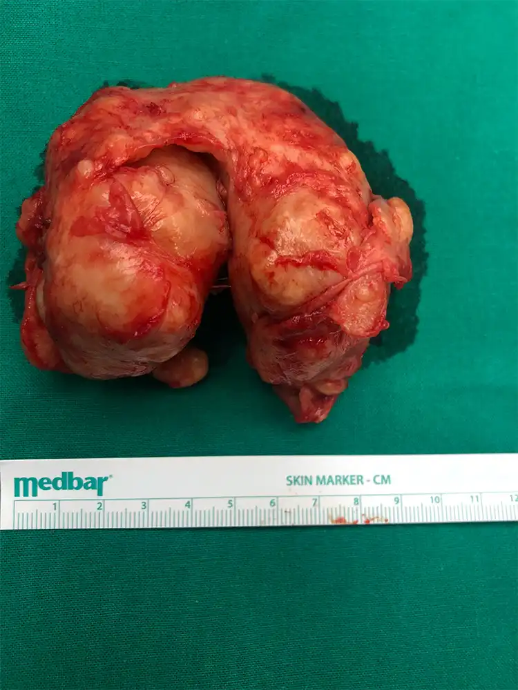 Παρασκεύασμα ανοιχτής Προστατεκτομής . Απεικονίζεται το ευμέγεθες αδένωμα που όπως φαίνεται αντιστοιχεί σε διάμετρο 10 εκ . και συνολικού βάρους 200 γρ. από τη βιοψία