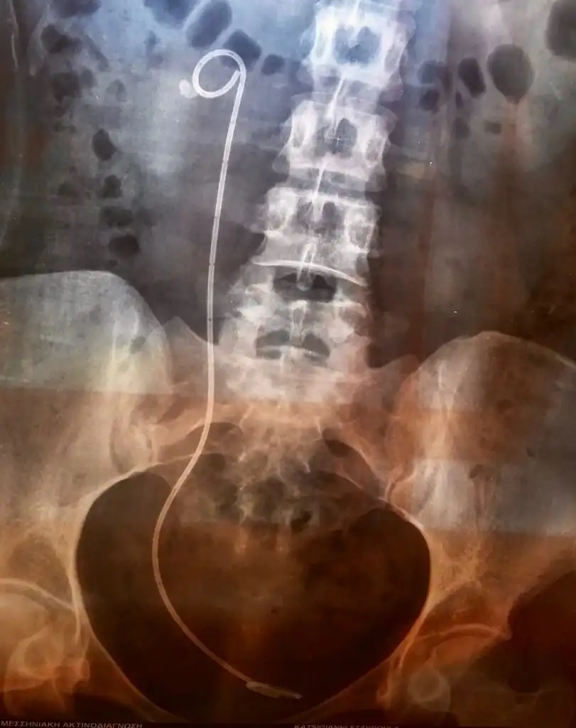 Λίθος νεφρού. Εύκαμπτη laser νεφρολιθοθρυψία.