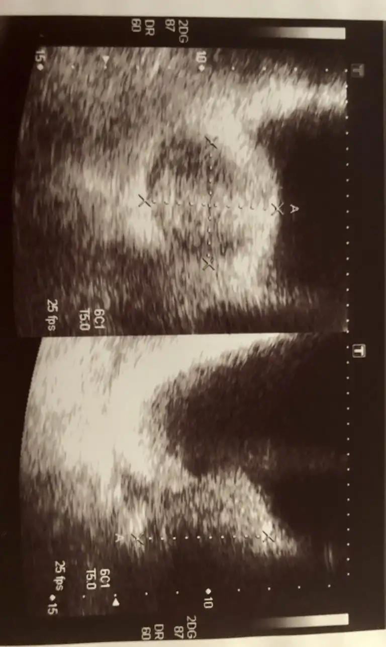 Υπέρηχος ΚΥΠ. Ενδοκυστική προβολή μέσου λοβού.
